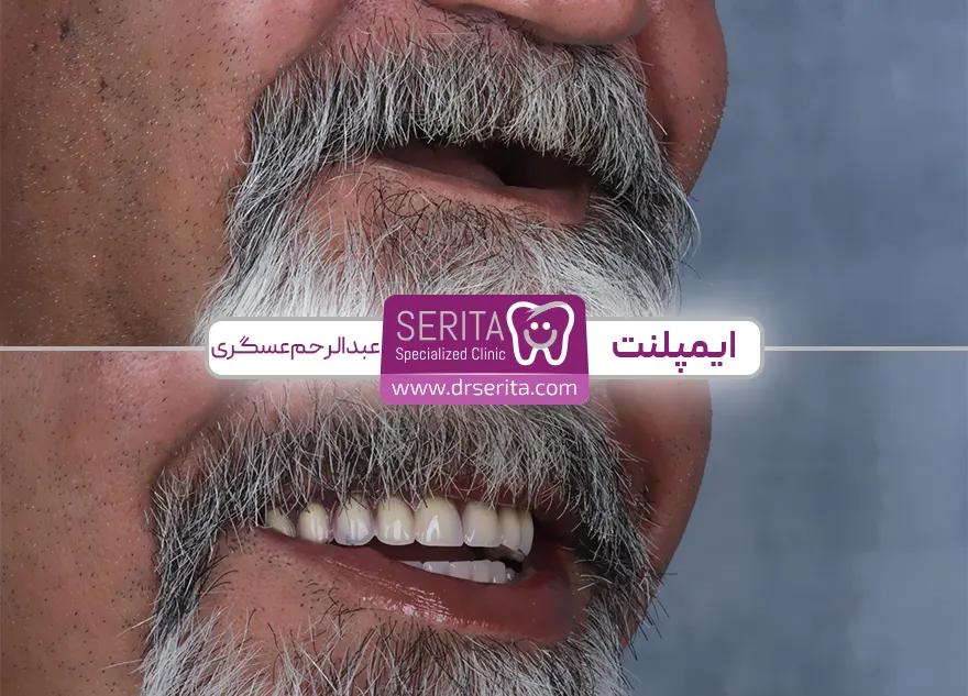 قبل و بعد ایملنت کامل دندان در کلینیک سریتا