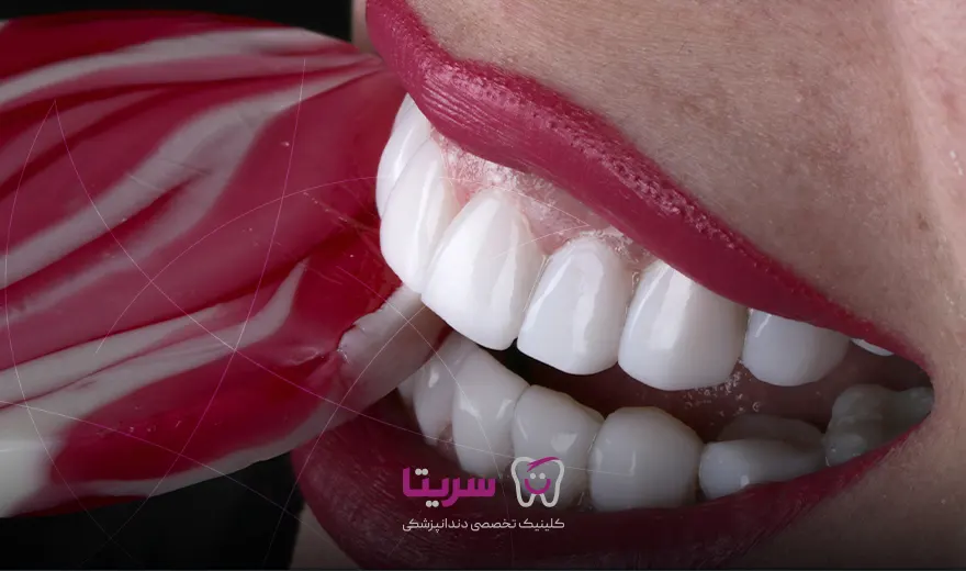 کامپوزیت دندان در کلینیک سریتا