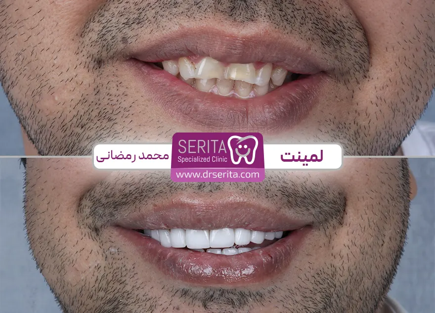 اصلاح نواقص دندان و طرح لبخند با لمینت دندان