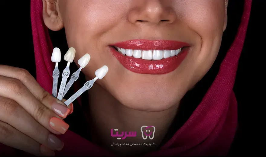 انواع رنگ کامپوزیت دندان در کلینیک سریتا