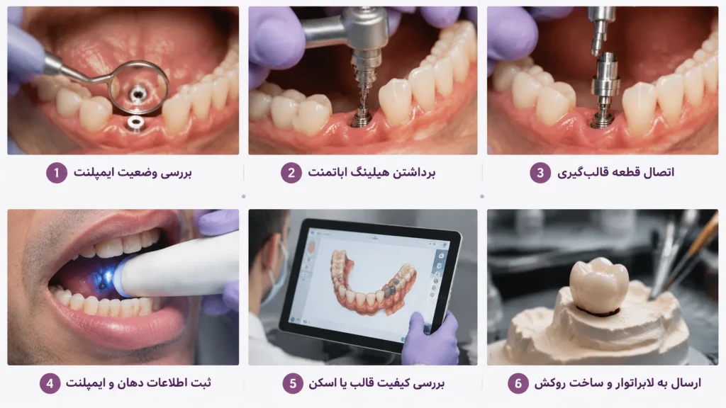 مراحل قالب‌گیری ایمپلنت دندان