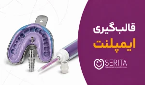 قالب‌گیری ایمپلنت چیست؟ مراحل، انواع و اهمیت آن در ساخت روکش