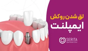 علت لق شدن و افتادن روکش ایمپلنت | دلایل، علائم و درمان‌های مؤثر