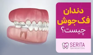 دندان فک جوش یا انکیلوز دندان چیست؟