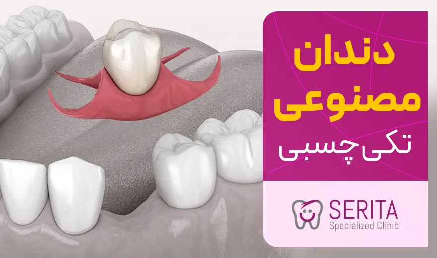 دندان مصنوعی تکی چسبی چیست؟