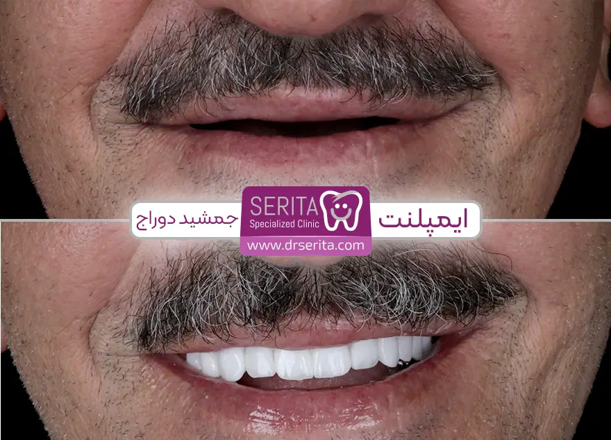 قبل و بعد ایمپلنت دندان