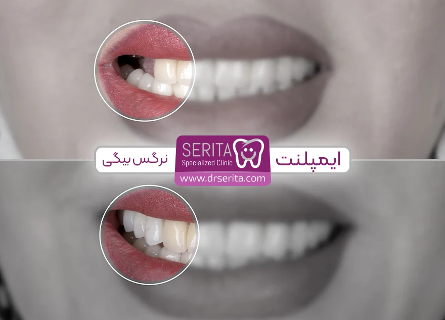 قبل و بعد ایمپلنت دندان کلینیک سریتا خانم بیگی پرکردن جای خالی دندان با ایمپلنت