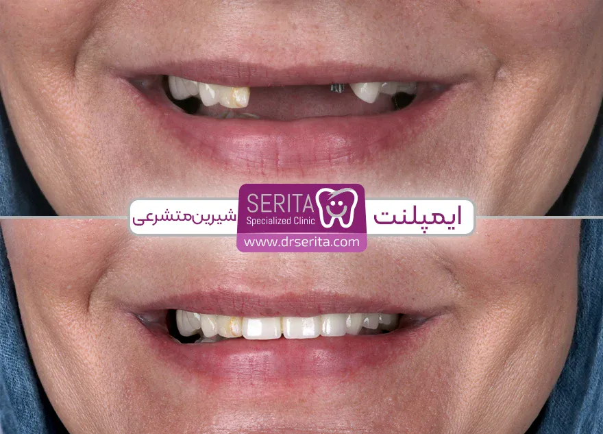 ایمپلنت دندان جلو عکس قبل و بعد
