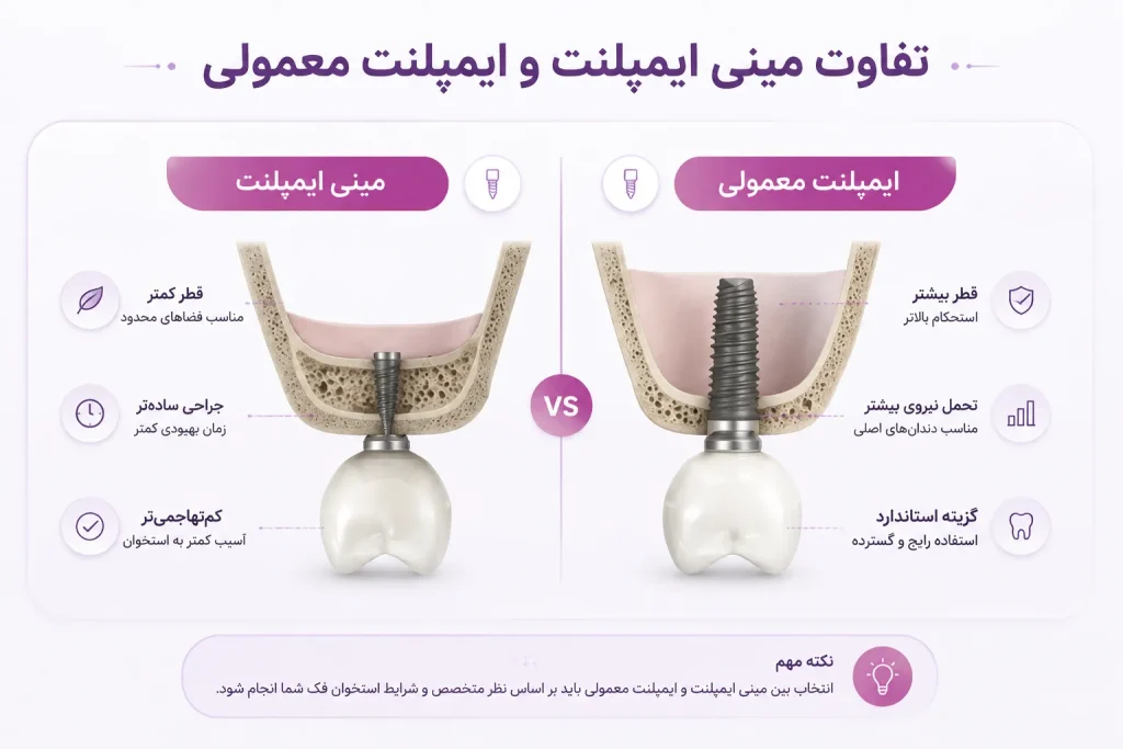 تفاوت مینی ایمپلنت و ایمپلنت معمولی