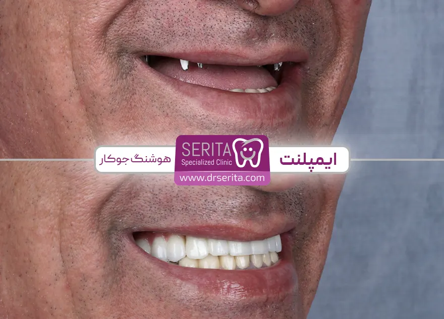 عکس قبل و بعد ایمپلنت دندان در کلینیک سریتا