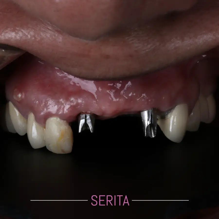 عکس قبل و بعد ایملپنت دندان جلو
