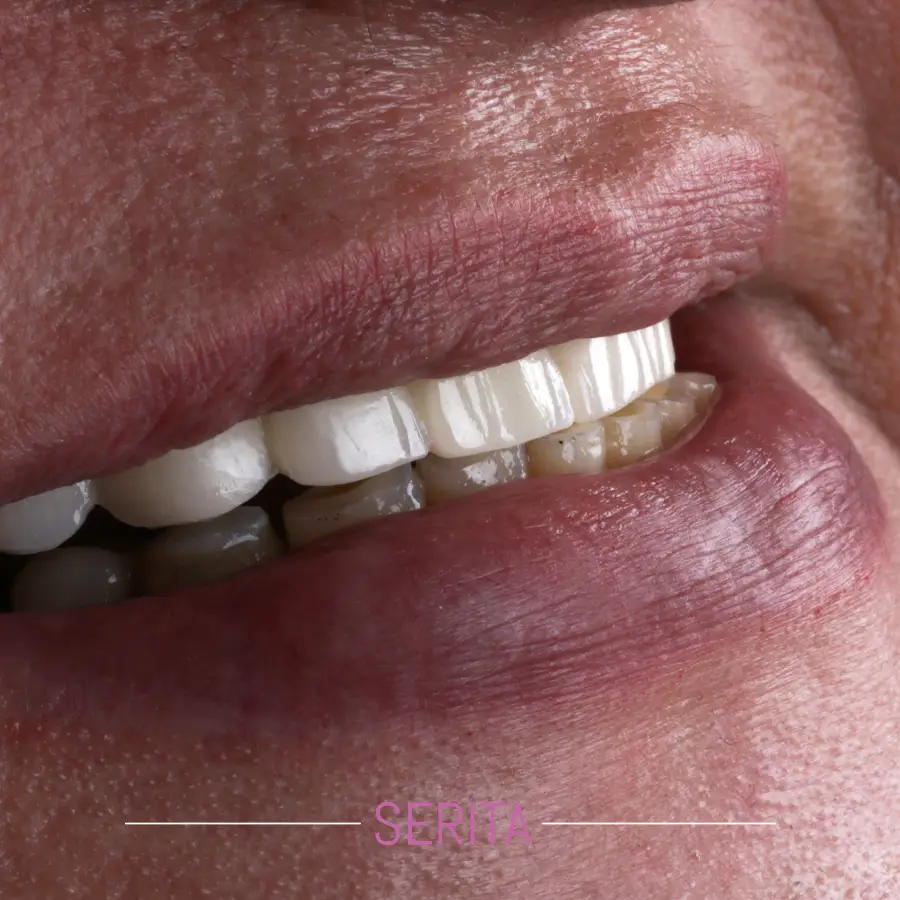 عکس نتیجه نهایی ایمپلنت دندان جلو