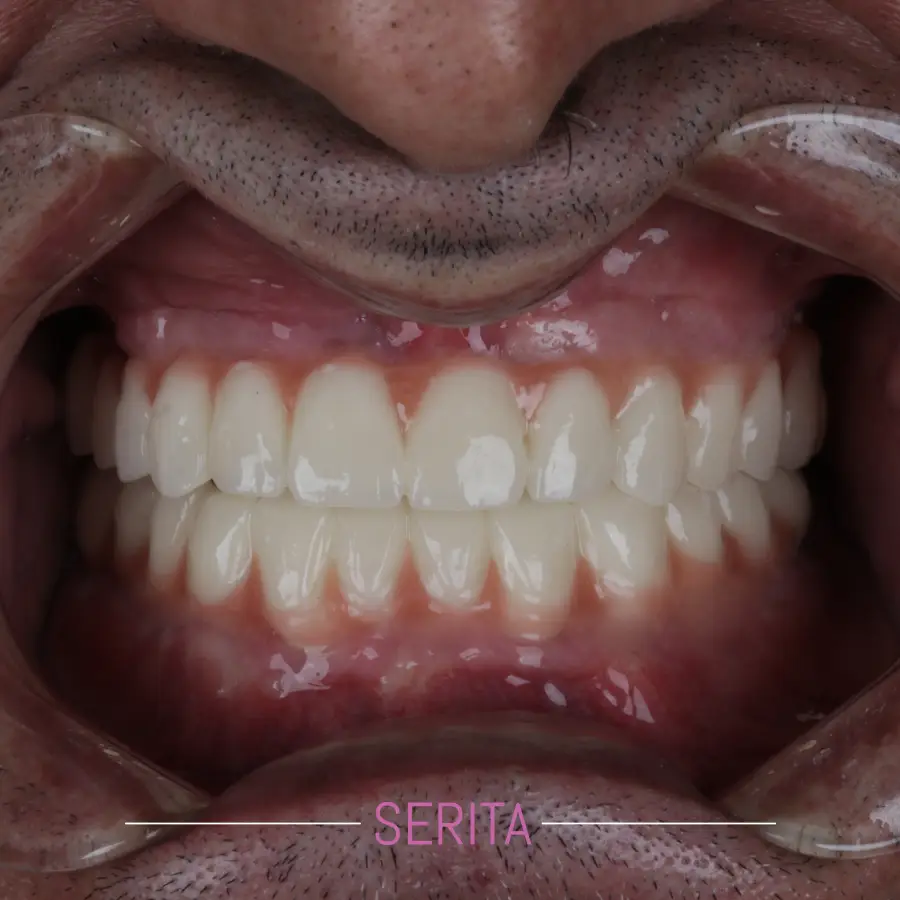 عکس قبل و بعد ایمپلنت دندان