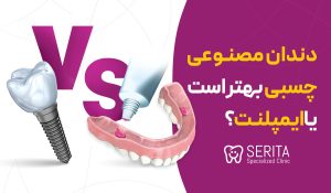 دندان مصنوعی چسبی بهتر است یا ایمپلنت؟