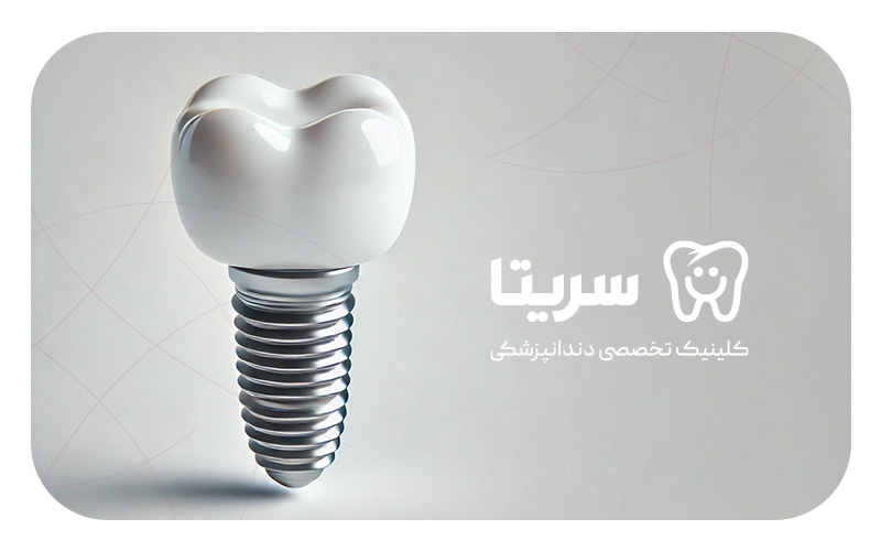 نمای نزدیک ایمپلنت دندان به عنوان بهترین روش کاشت دندان دائمی؛ بررسی مزایا، کاربرد و ماندگاری ایمپلنت دندان در کلینیک تخصصی