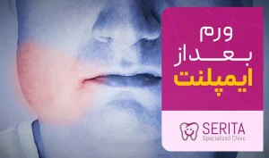 ورم بعد از ایمپلنت چند روز طول میکشد؟