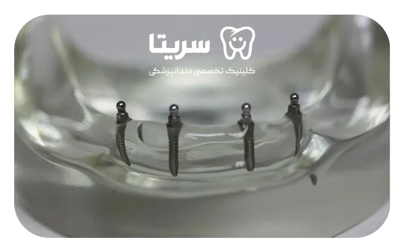 قرارگیری مینی ایمپلنت دندان داخل فک