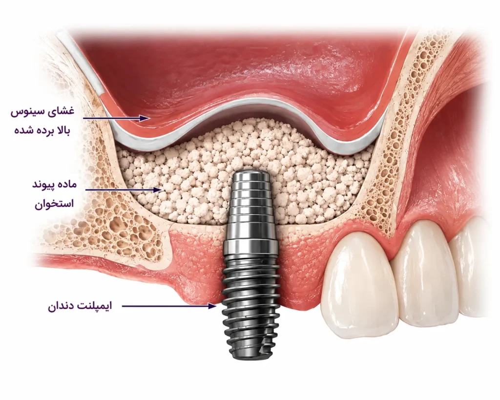 نمایی از آنچه در سینوس لیفت اتفاق می‌افتد.