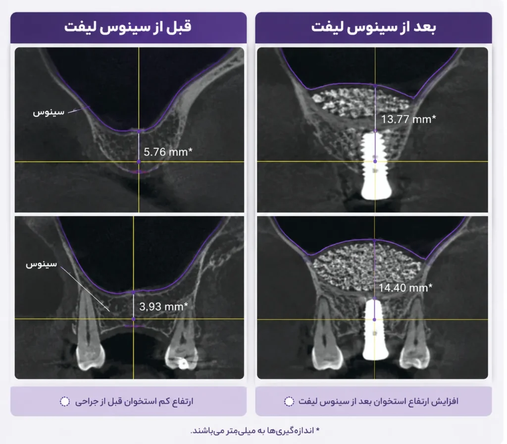 عکس سینوس لیفت در تصویربرداری تخصصی