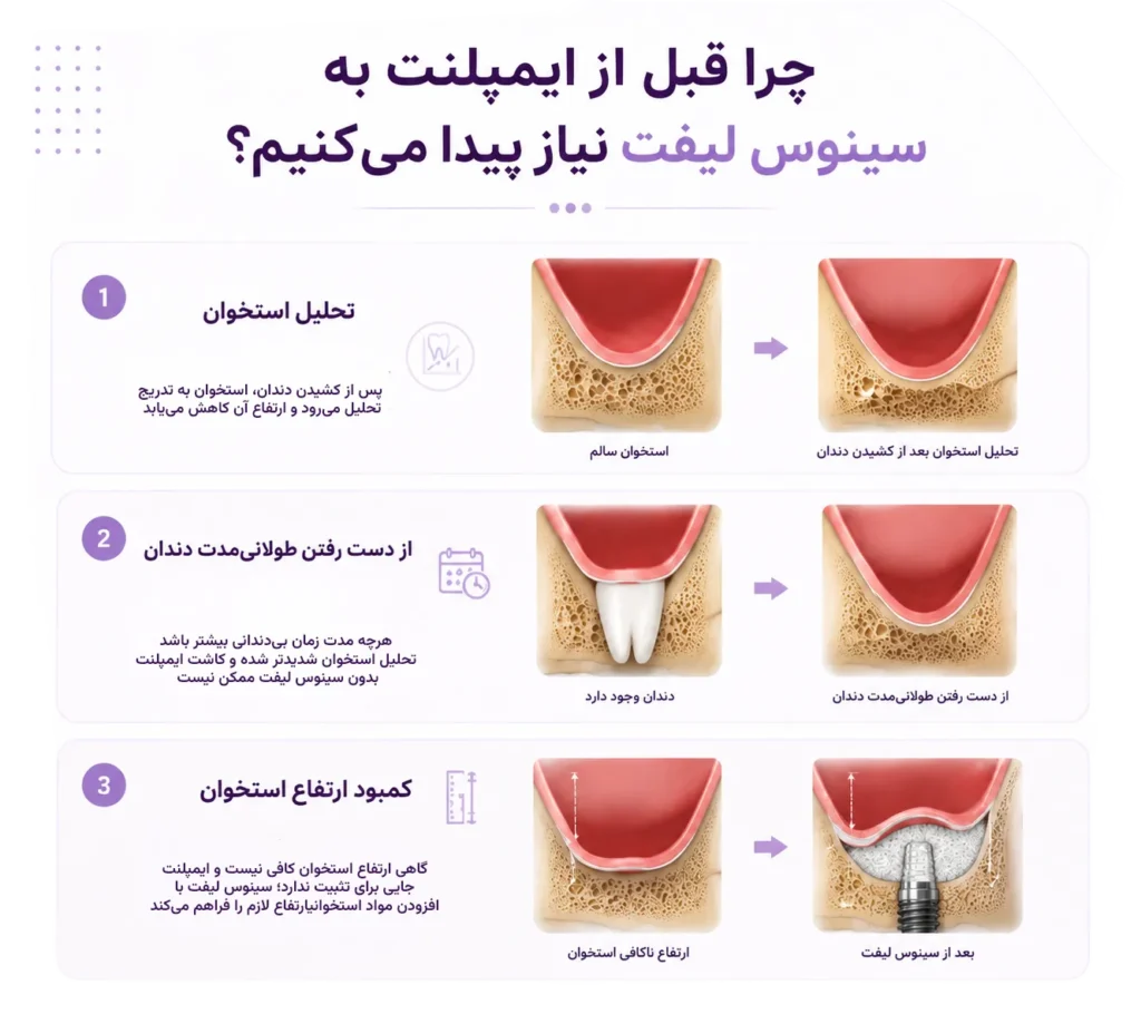 چرا قبل از ایمپلنت به سینوس لیفت نیاز پیدا می‌کنیم؟