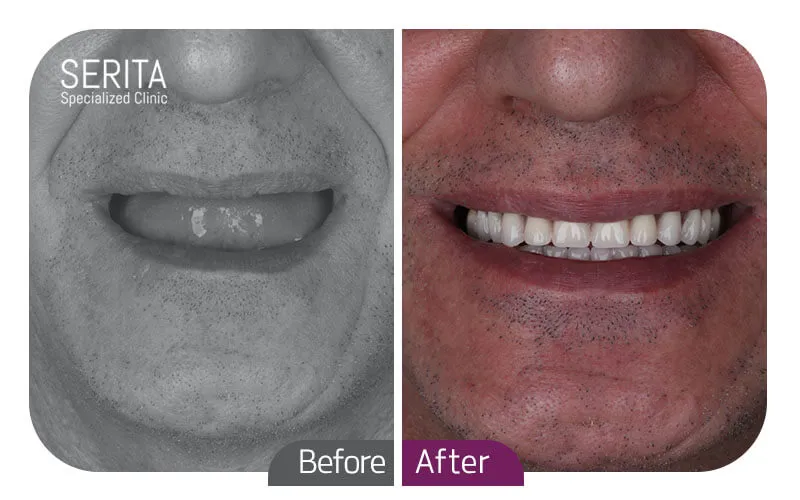 قبل و بعد ایمپلنت اشترومن