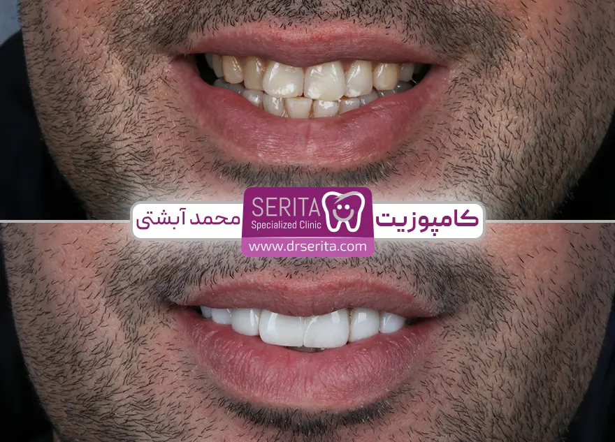 قبل و بعد از کامپوزیت دندان در سریتا