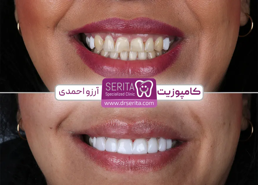 عکی قبل و بعد از کامپوزیت دندان جلو