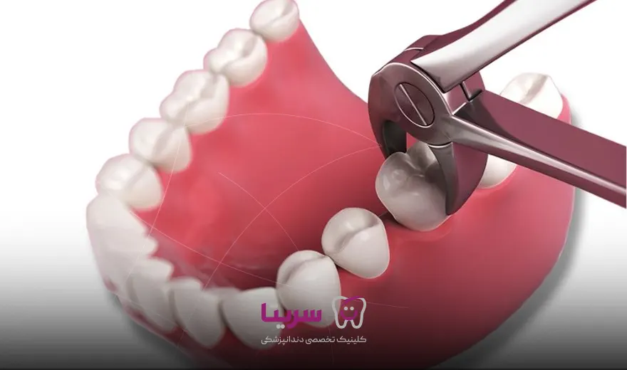 مراقبت های بعد از کشیدن دندان برای ایمپلنت