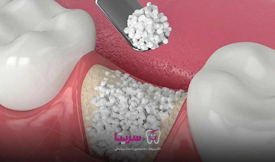 بهترین زمان کاشت ایمپلنت و پیوند استخوان یکی از عوامل مهم در تعیین زمان ایمپلنت دندان است.