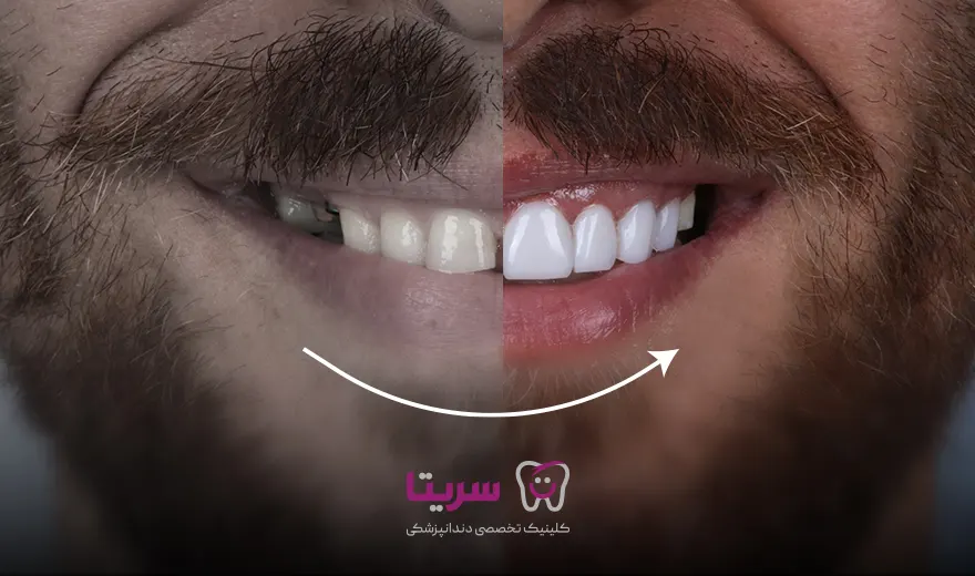 قبل و بعد کامپوزیت دندان 