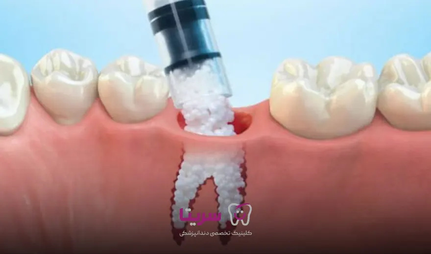 مراقبت های بعد از پیوند استخوان برای ایمپلنت دندان