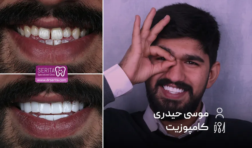 عکس قبل و بعد از کامپوزیت دندان
