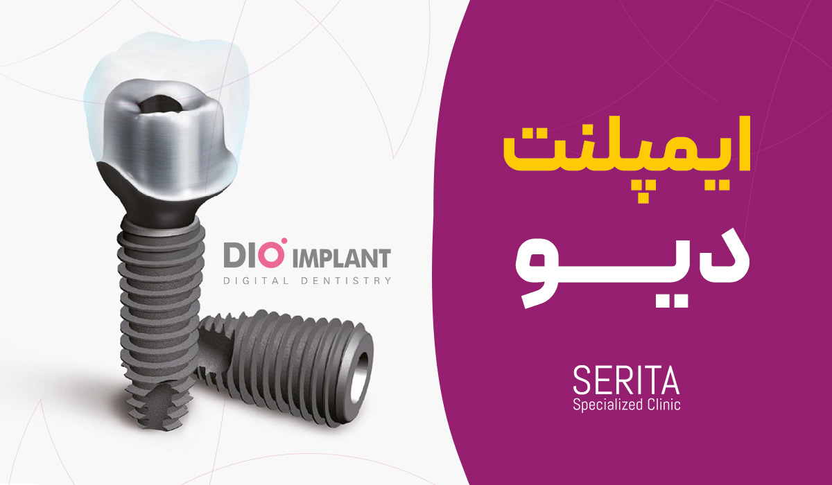 ایمپلنت دندانی دیو DIO کره‌ای