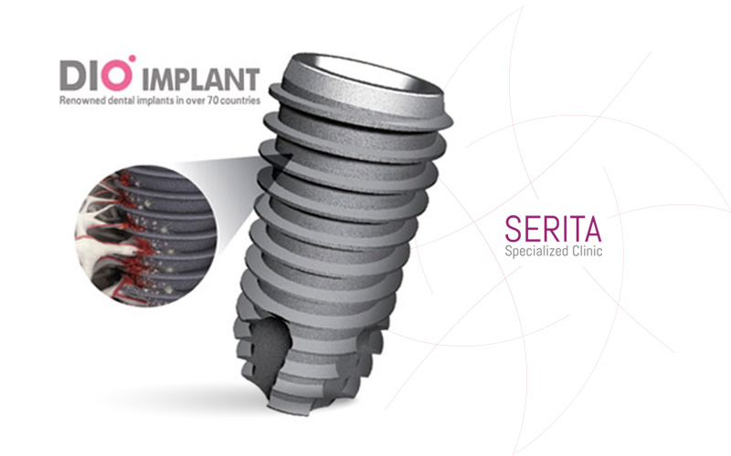 قسمتی از پایه ایمپلنت دیو در نمای بزرگتر