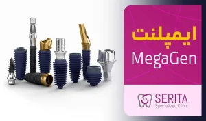 بررسی و قیمت ایمپلنت کره ای مگاژن (MegaGen)