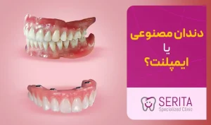 دندان مصنوعی بهتر است یا ایمپلنت؟