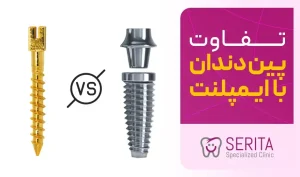 تفاوت پین دندان با ایمپلنت دندان