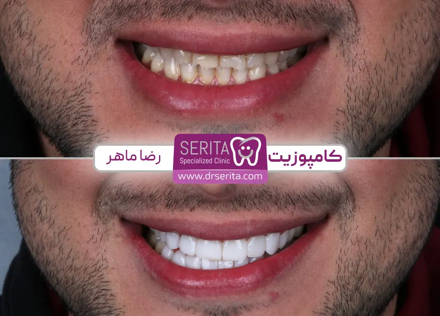 جراحی لثه برای کامپوزیت دندان