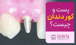 پست و کور دندان چیست و چگونه انجام می‌شود؟