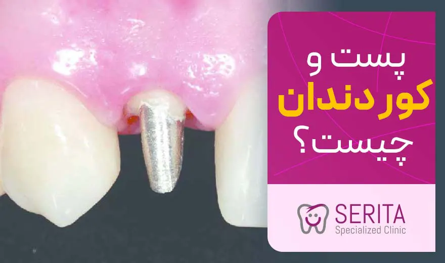 پست و کور دندان چیست؟