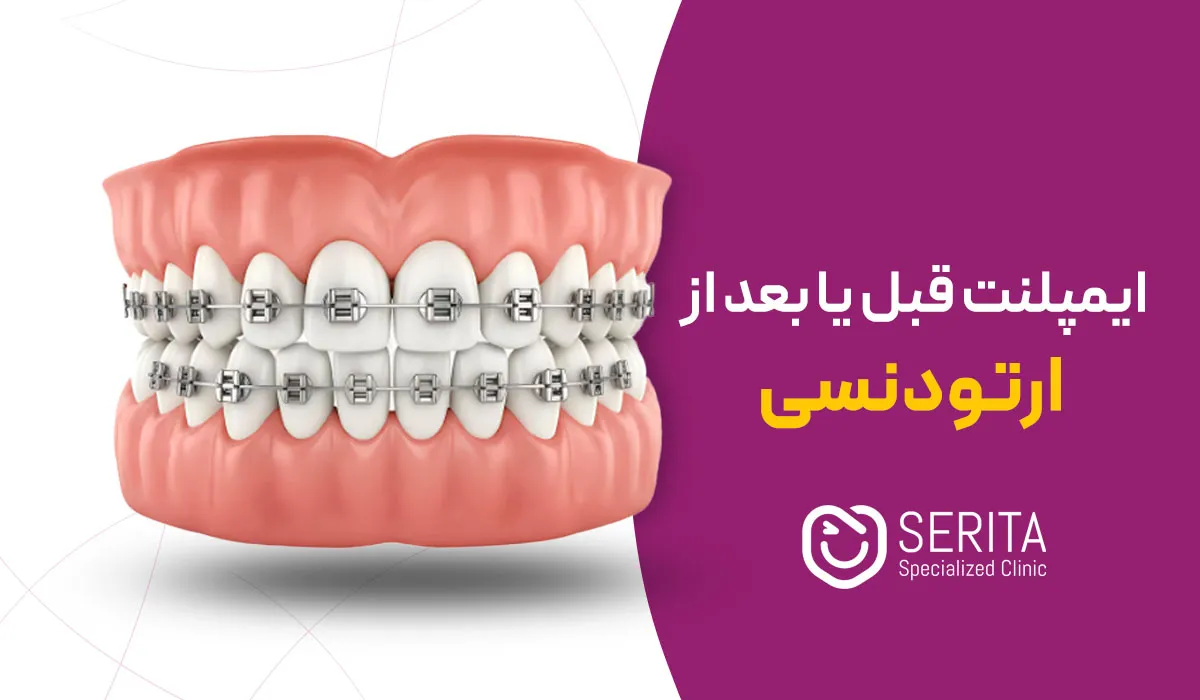 ایمپلنت قبل یا بعد از ارتودنسی؛ کدام گزینه برای شما بهتر است؟
