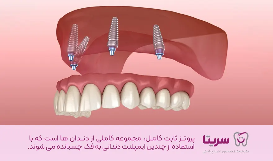 پروتز کامل یا دندان مصنوعی ثابت کامل بر پایه ایمپلنت