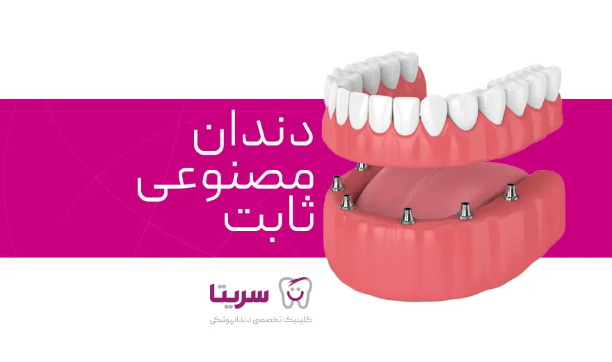 دندان مصنوعی ثابت بر پایه ایمپلنت یا اوردنچر