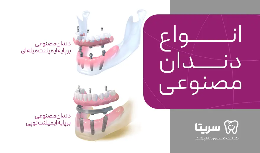 انواع دندان مصنوعی بر پایه ایمپلنت، میله ای، توپی
