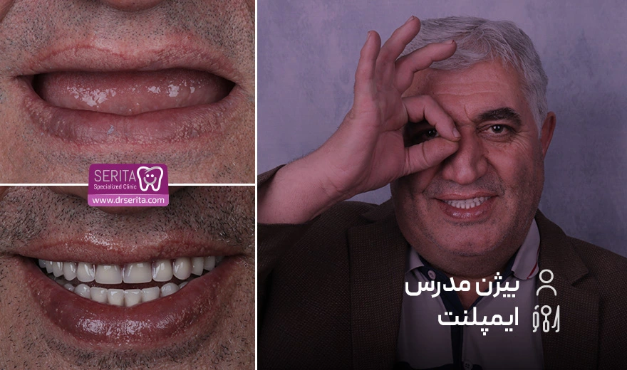 قبل و بعد از ایمپلنت دندان