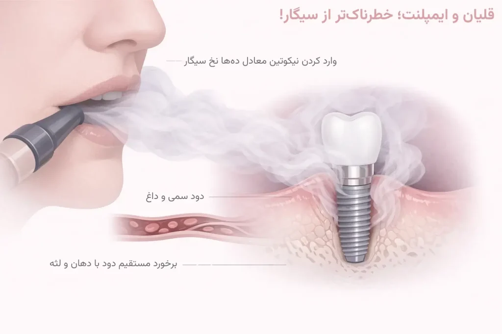 اینفوگرافیک تاثیر قلیان بر ایمپلنت دندان
