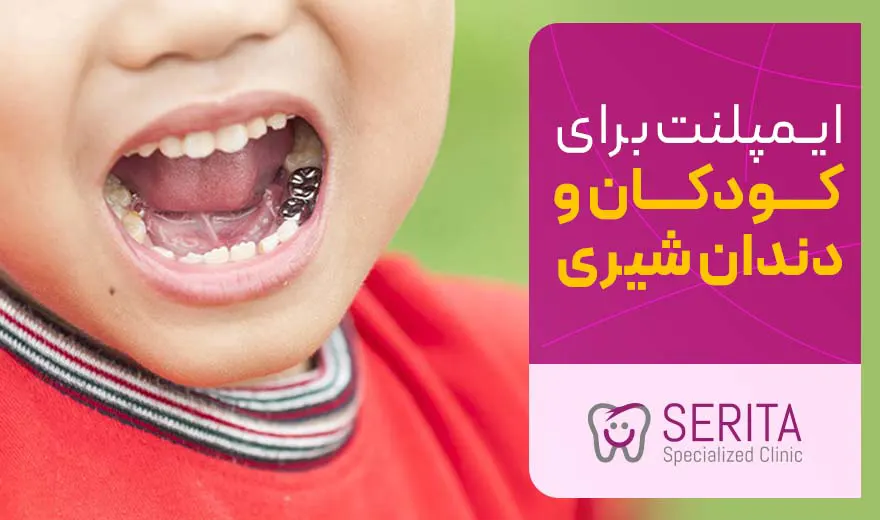 ایمپلنت برای کودکان و دندان شیری