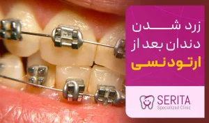 زرد شدن دندان بعد از ارتودنسی