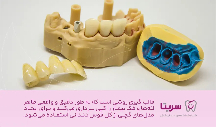قالبگیری ایمپلنت دندان چگونه است؟