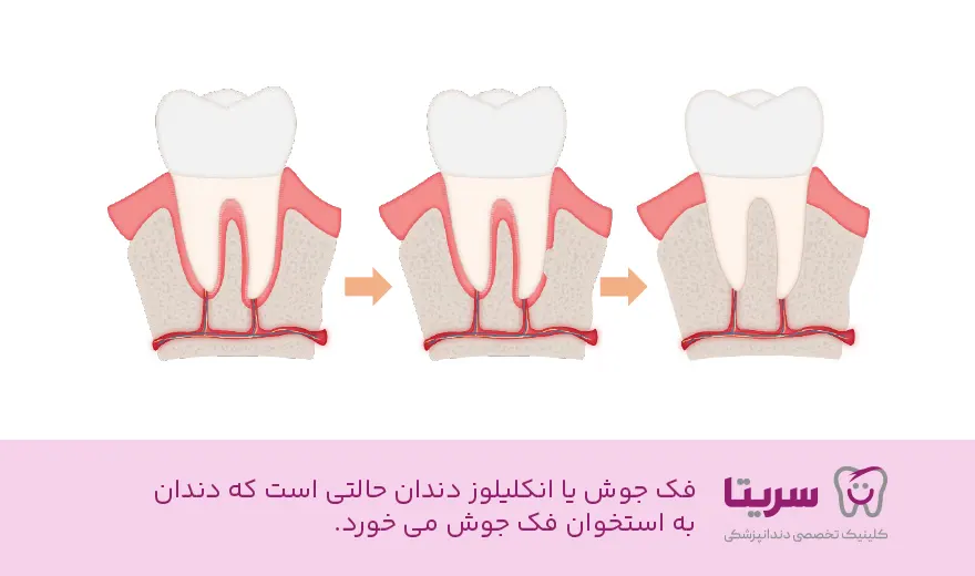 دندان فک جوش چیست؟